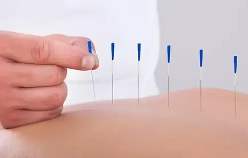 Acupunturista